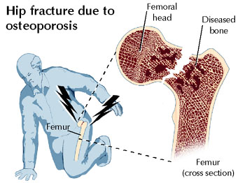 Hip fracture due to osteoporosis